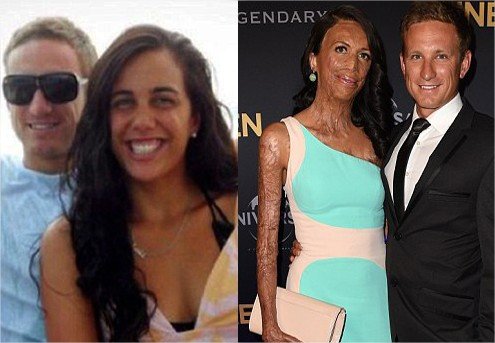 This Ex-Model Australian Turia Pitt Suffered 65 Percent Burn Injury