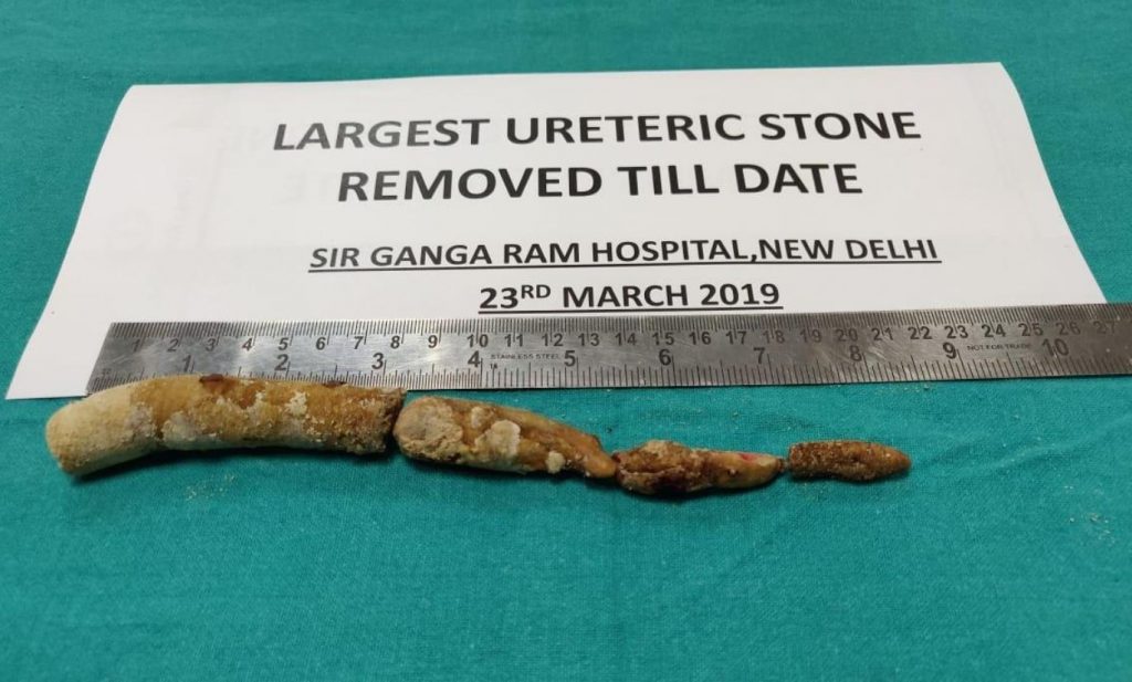 Sir Ganga Ram doctors remove longest ureteric stone 1