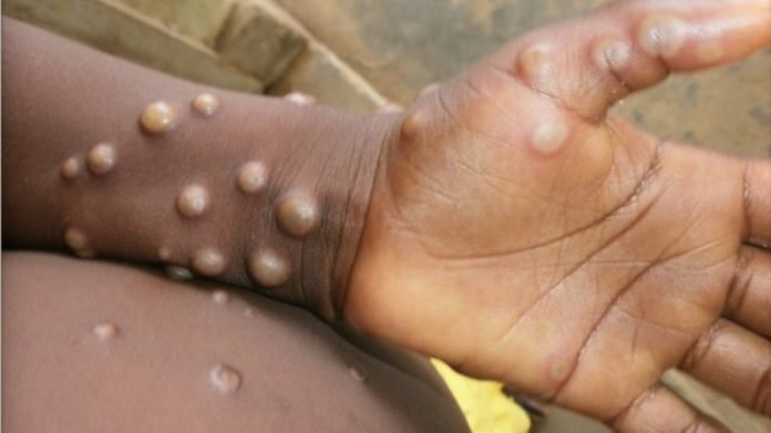 Monkeypox.(photo:Twitter)