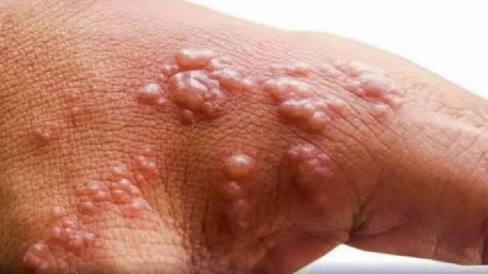 Are-kids-pregnant-women-more-at-risk-for-monkeypox